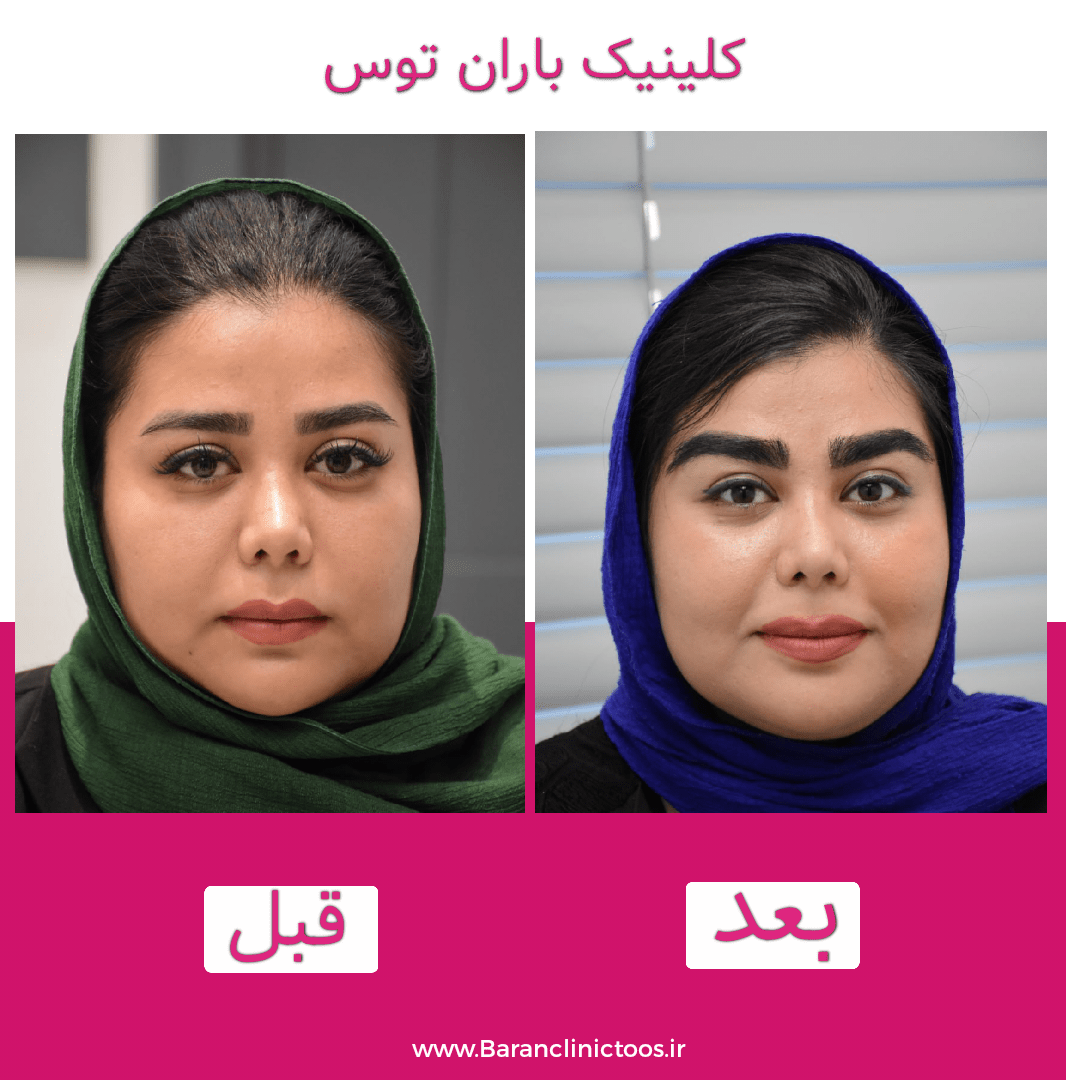 قبل و بعد کاشت ابرو